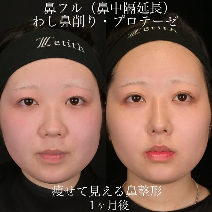 上木原医師による鼻整形の術前/術後1ヶ月