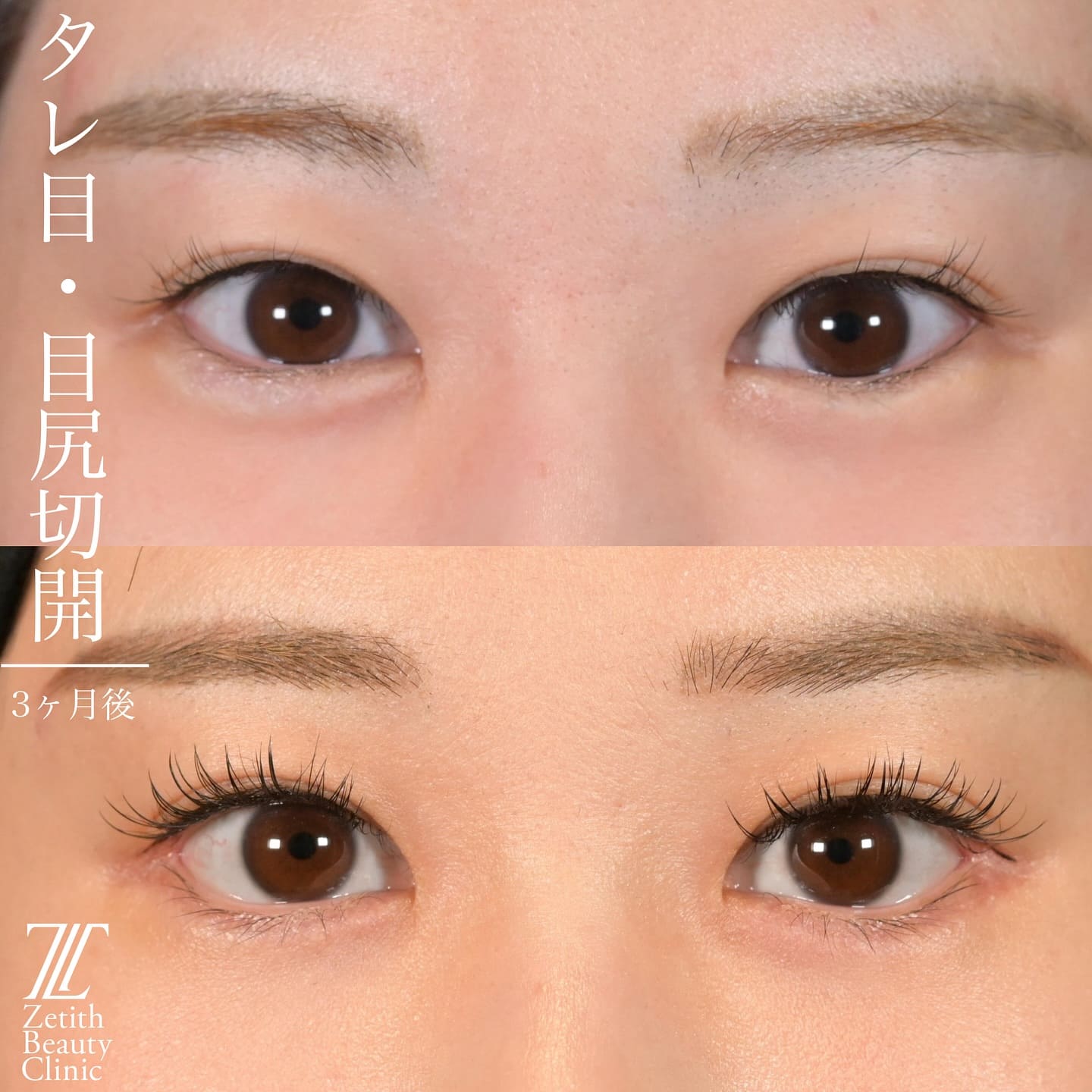 上木原医師による目元形成の術前/術後３ヶ月