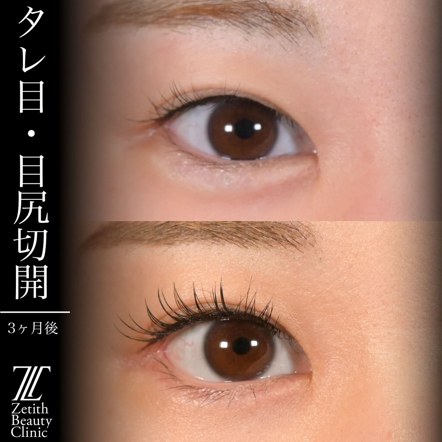 上木原医師による目元形成の術前/術後３ヶ月 After 