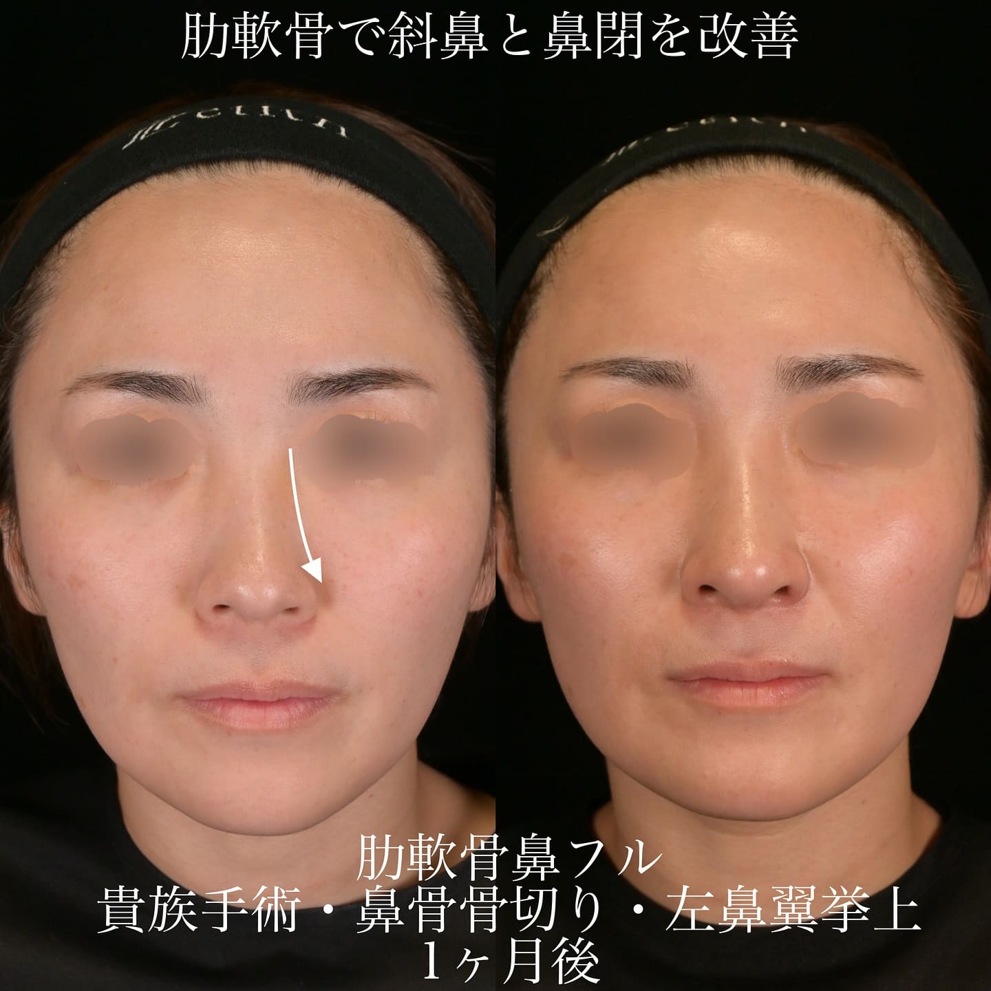 上木原医師による鼻整形の術前/術後1ヶ月