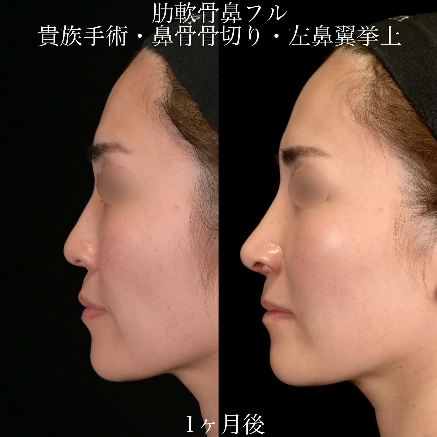 上木原医師による鼻整形の術前/術後1ヶ月 术后 