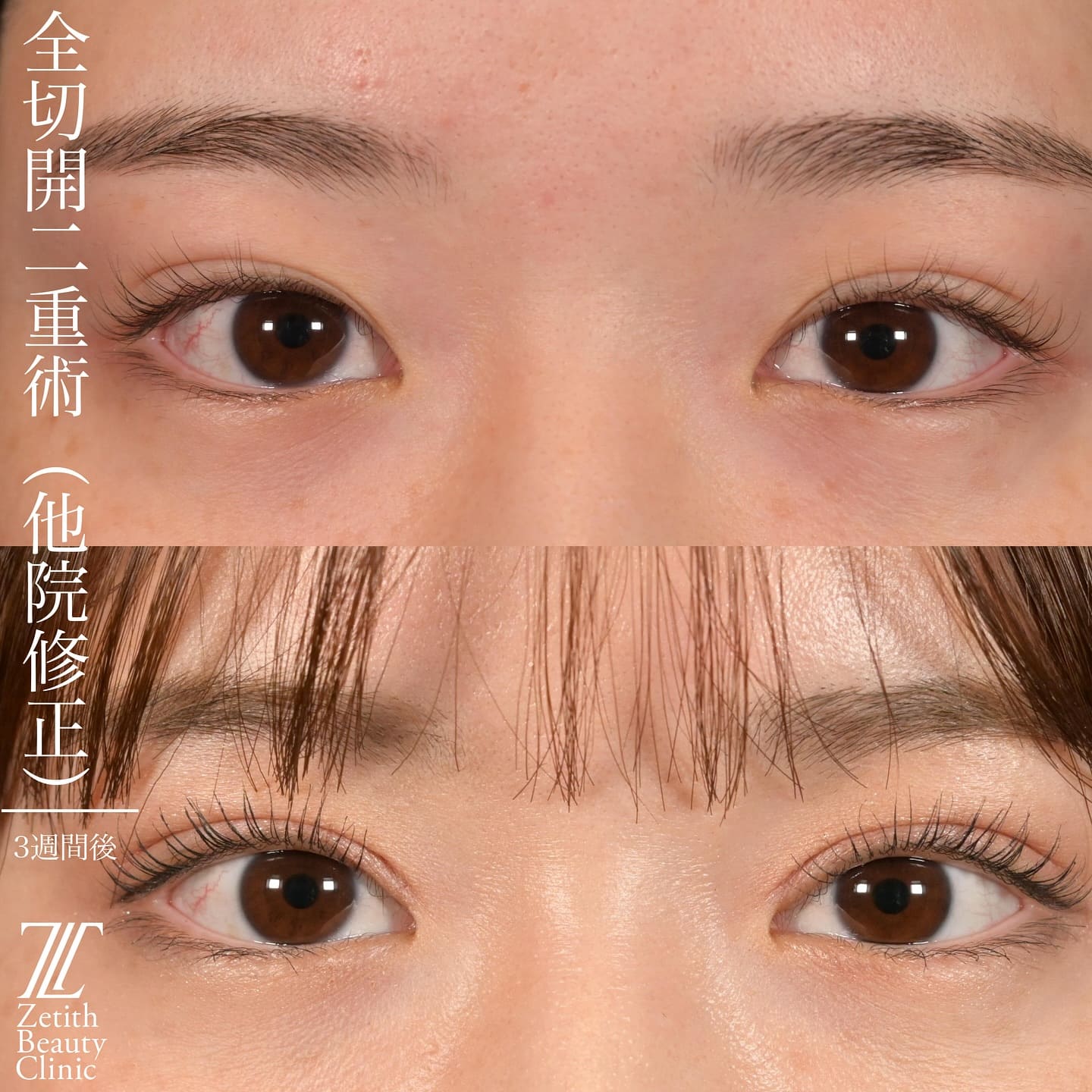 上木原 医師による全切開二重術の術前/術後３週間 Sau 
