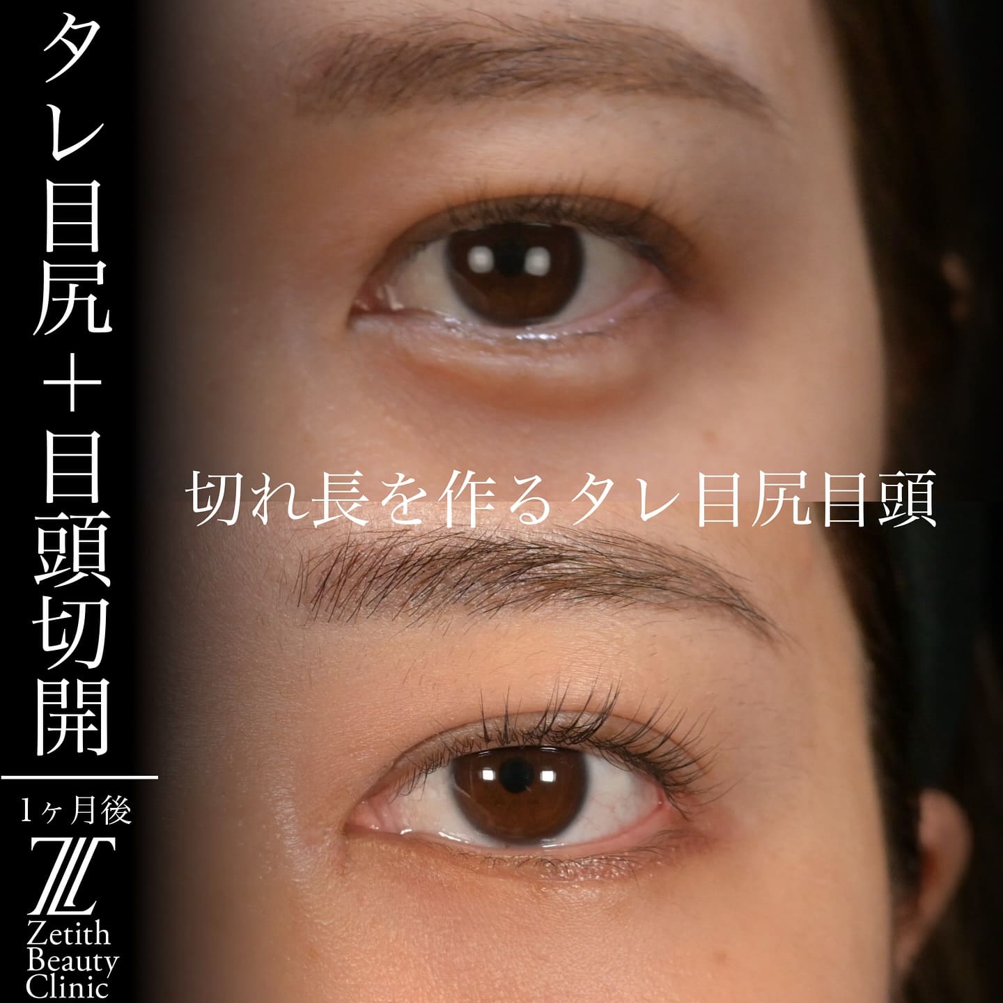 上木原医師による目元形成の術前/術後1ヶ月
