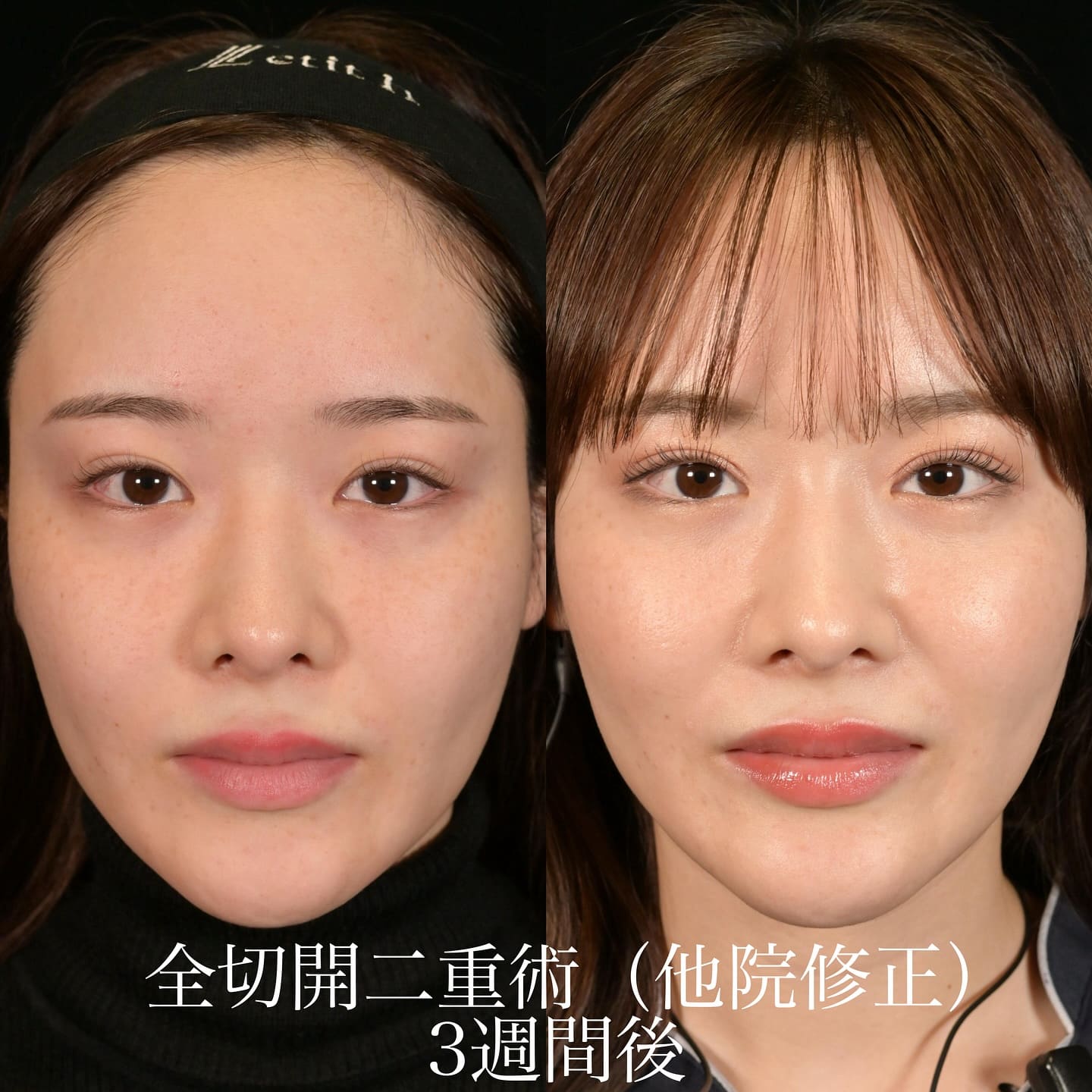 上木原 医師による全切開二重術の術前/術後３週間