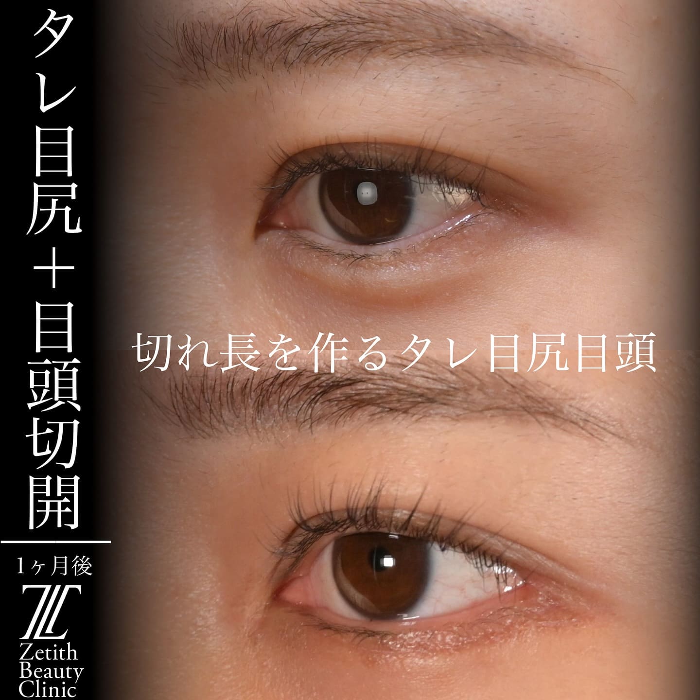 上木原医師による目元形成の術前/術後1ヶ月 Дараа 