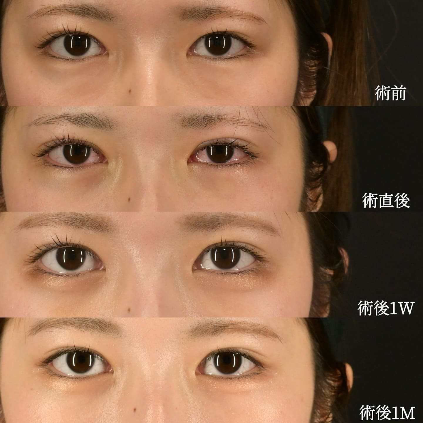 沈医師による目元形成の術前/術後1ヶ月 After 
