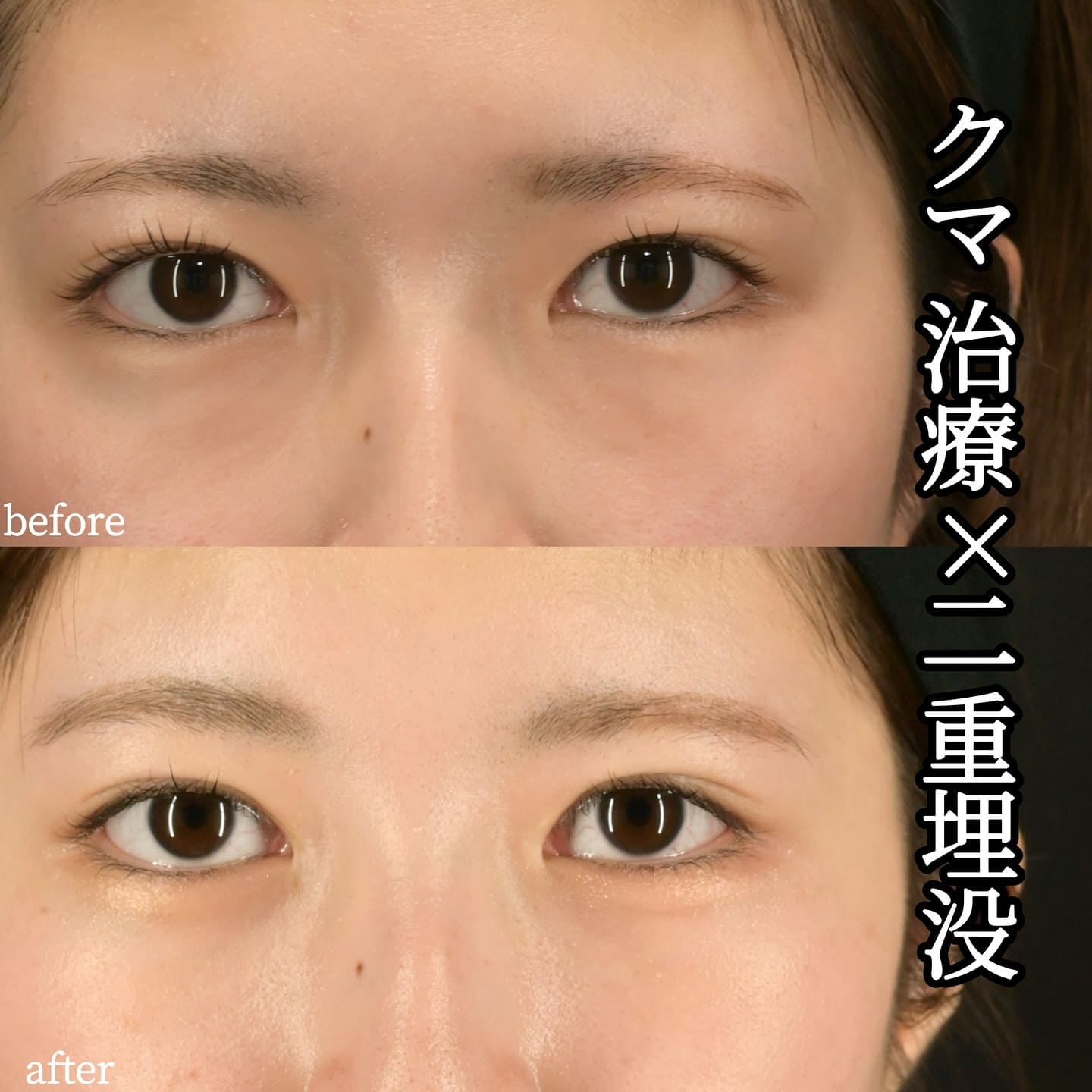 沈医師による目元形成の術前/術後1ヶ月