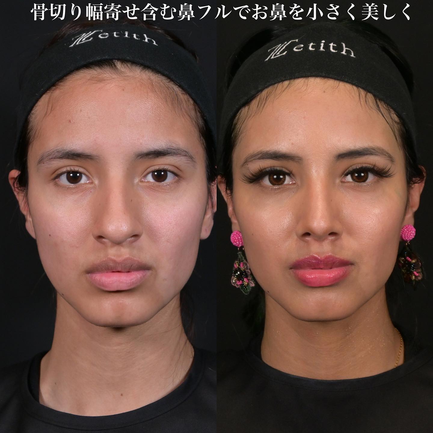 鉄医師による鼻整形の術前/術後3ヶ月