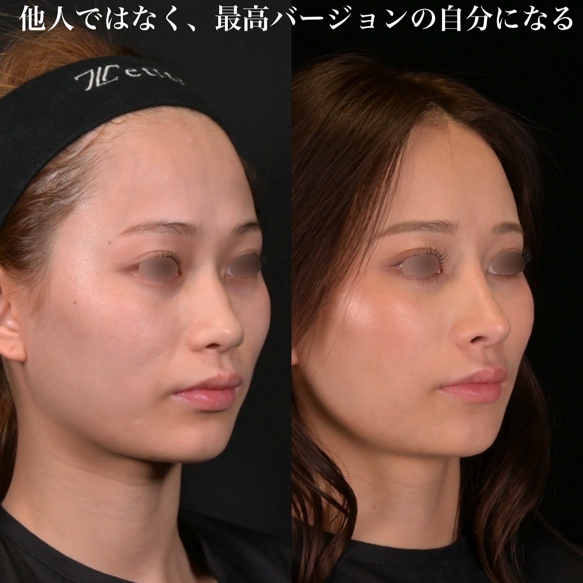 鉄医師による鼻整形の術前/術後一年半 术后 