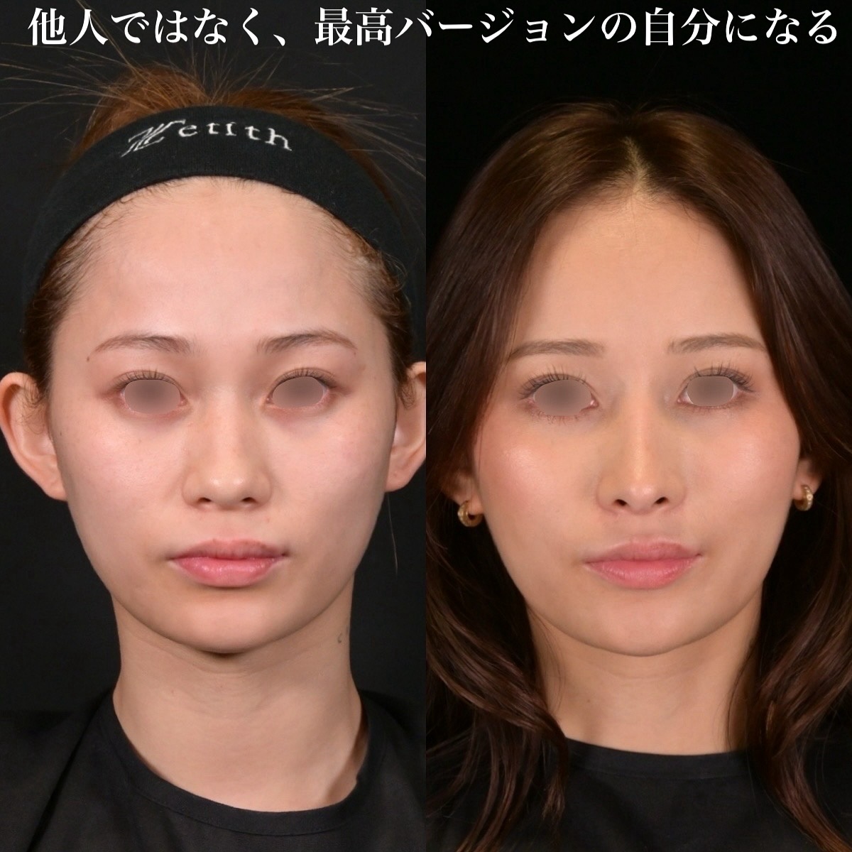 鉄医師による鼻整形の術前/術後一年半