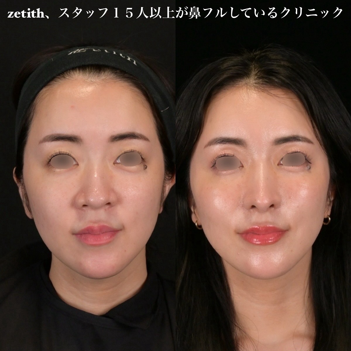 鉄医師による鼻整形の術前/術後3ヶ月