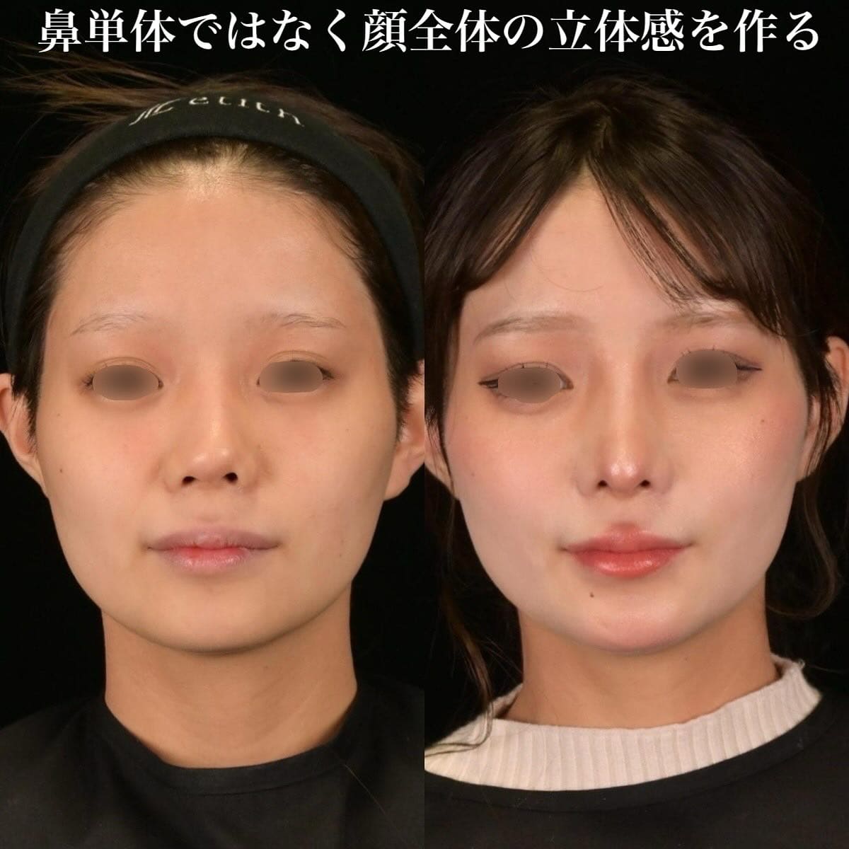 鉄医師による鼻整形の術前/術後1ヶ月