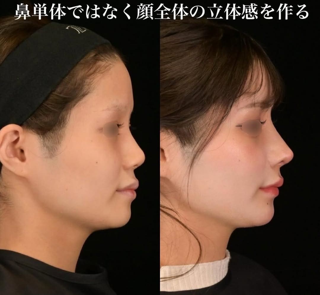 鉄医師による鼻整形の術前/術後1ヶ月 施術後 