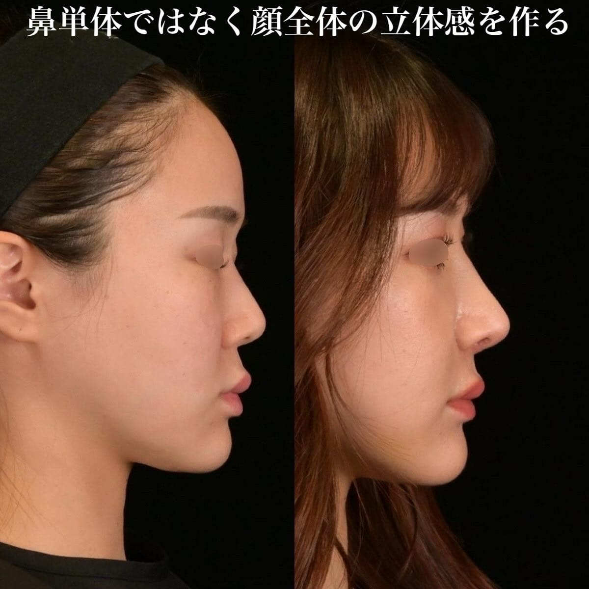 鉄医師による鼻整形の術前/術後2週間 术后 