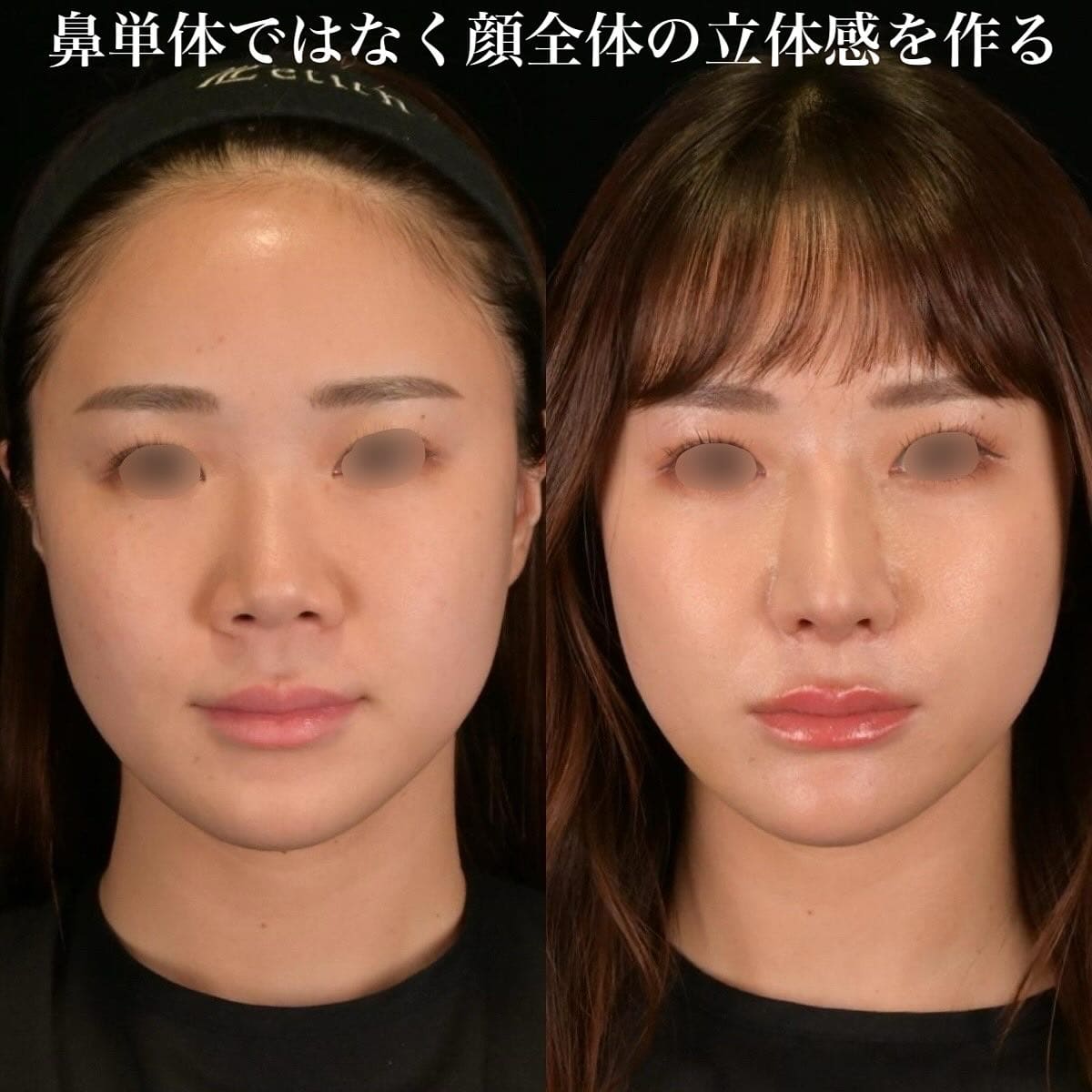 鉄医師による鼻整形の術前/術後2週間
