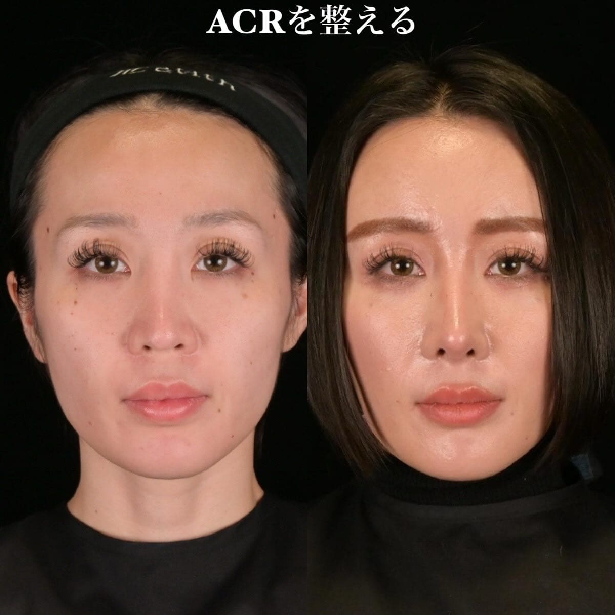 鉄医師による鼻整形の術前/術後３ヶ月