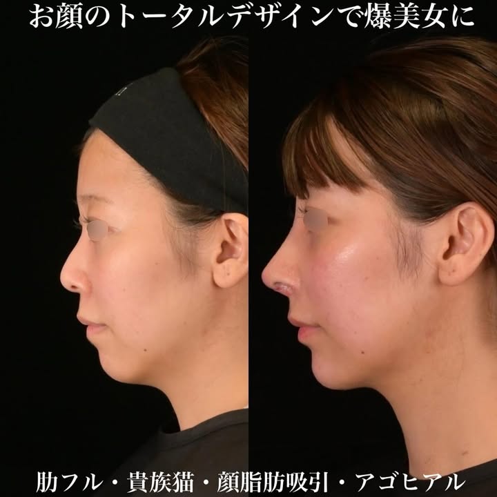 鉄医師による鼻整形の術前/術後1週間 After 