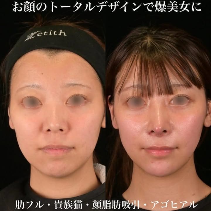 鉄医師による鼻整形の術前/術後1週間