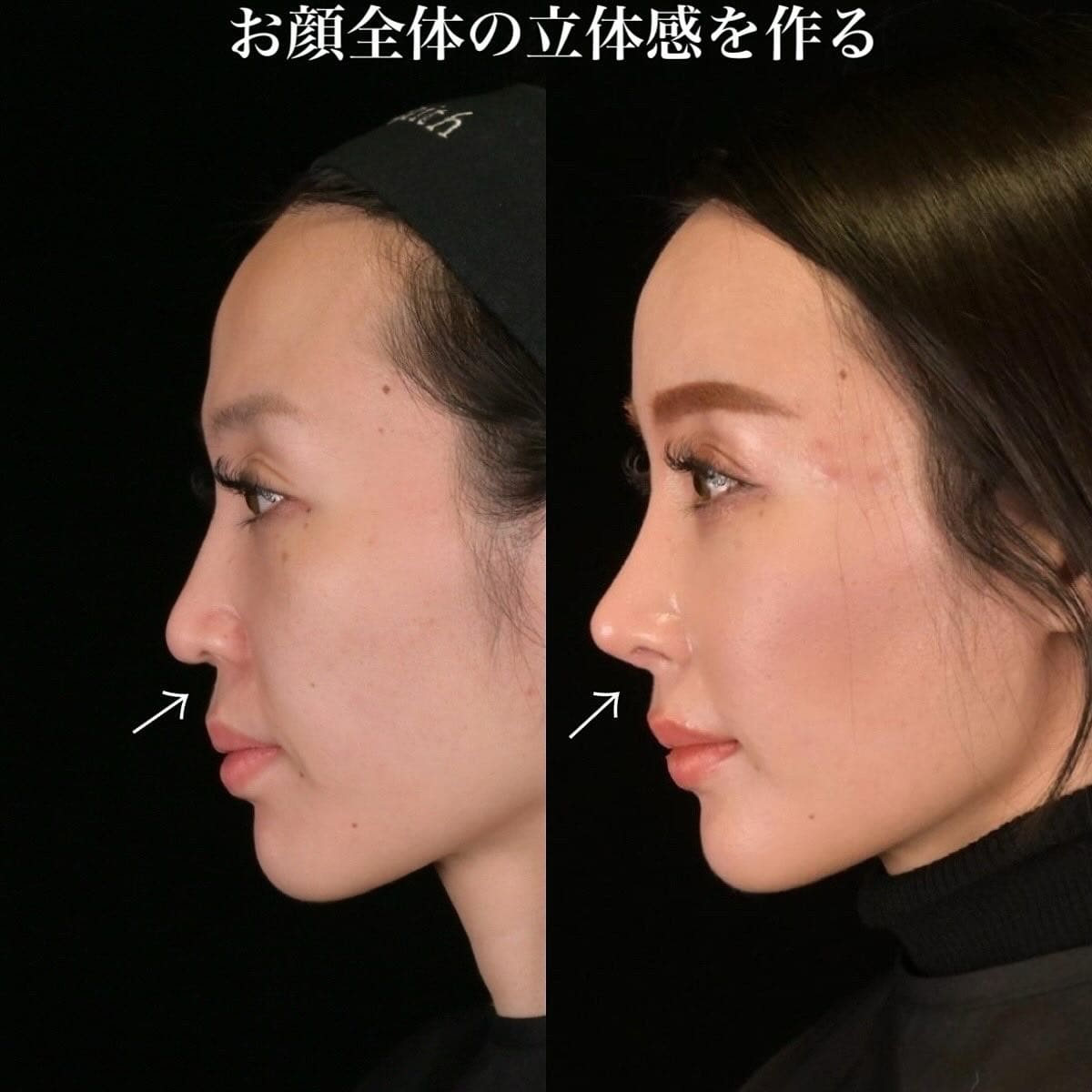 鉄医師による鼻整形の術前/術後３ヶ月 施術後 
