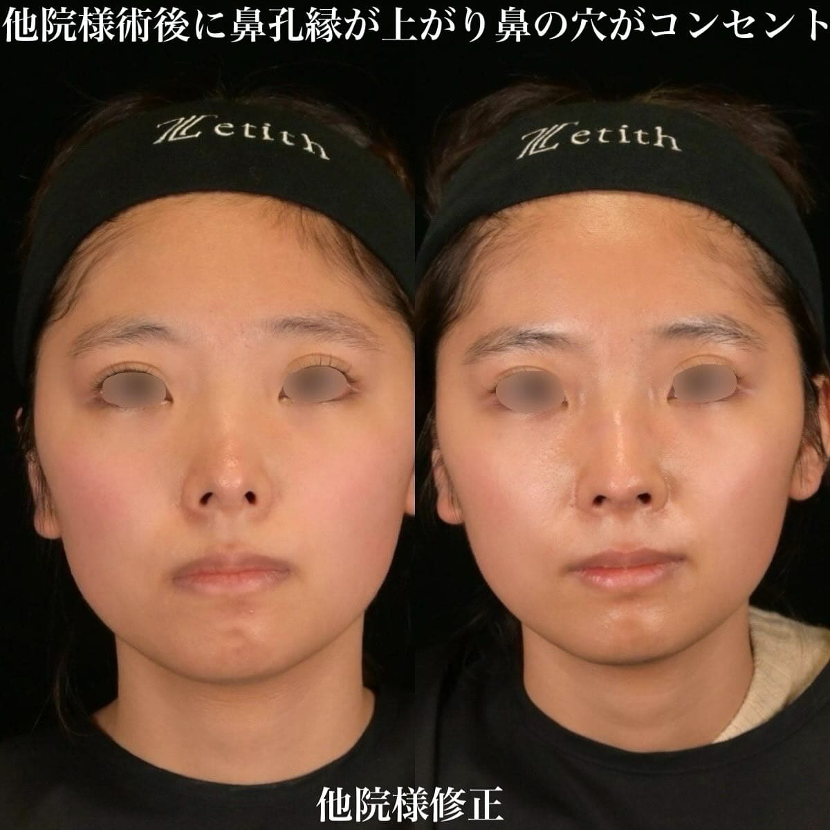 鉄医師による鼻整形の術前/術後1ヶ月