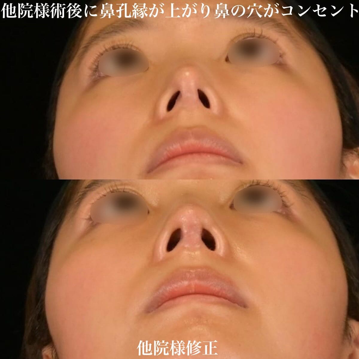 鉄医師による鼻整形の術前/術後1ヶ月 术后 