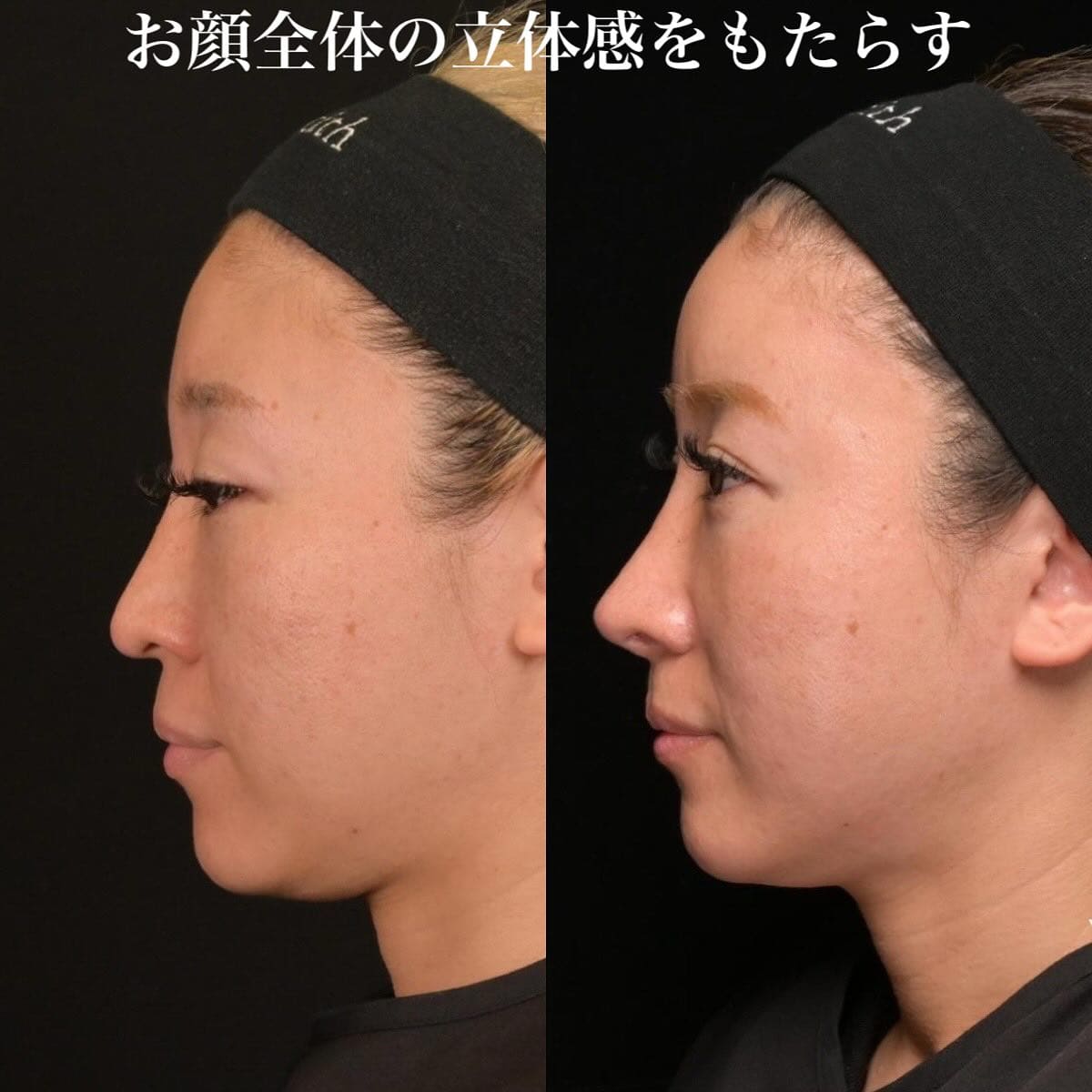 鉄医師による鼻整形の術前/術後6ヶ月 施術後 