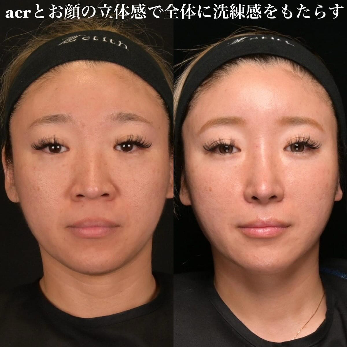 鉄医師による鼻整形の術前/術後6ヶ月