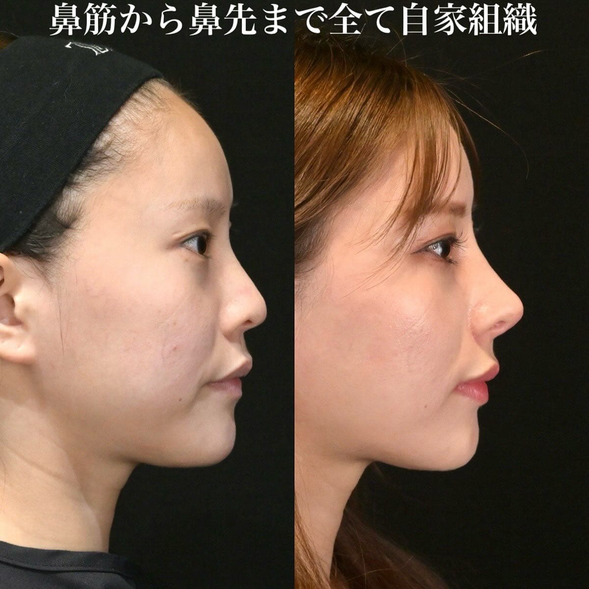 鉄医師による鼻整形の術前/術後3ヶ月 หลัง 