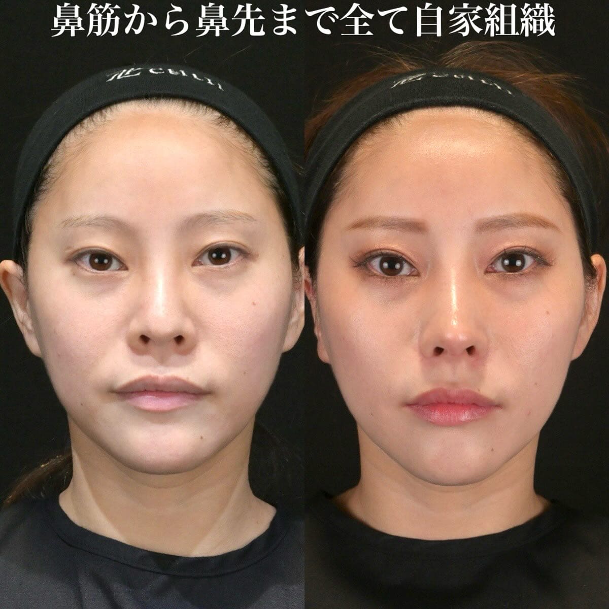 鉄医師による鼻整形の術前/術後3ヶ月