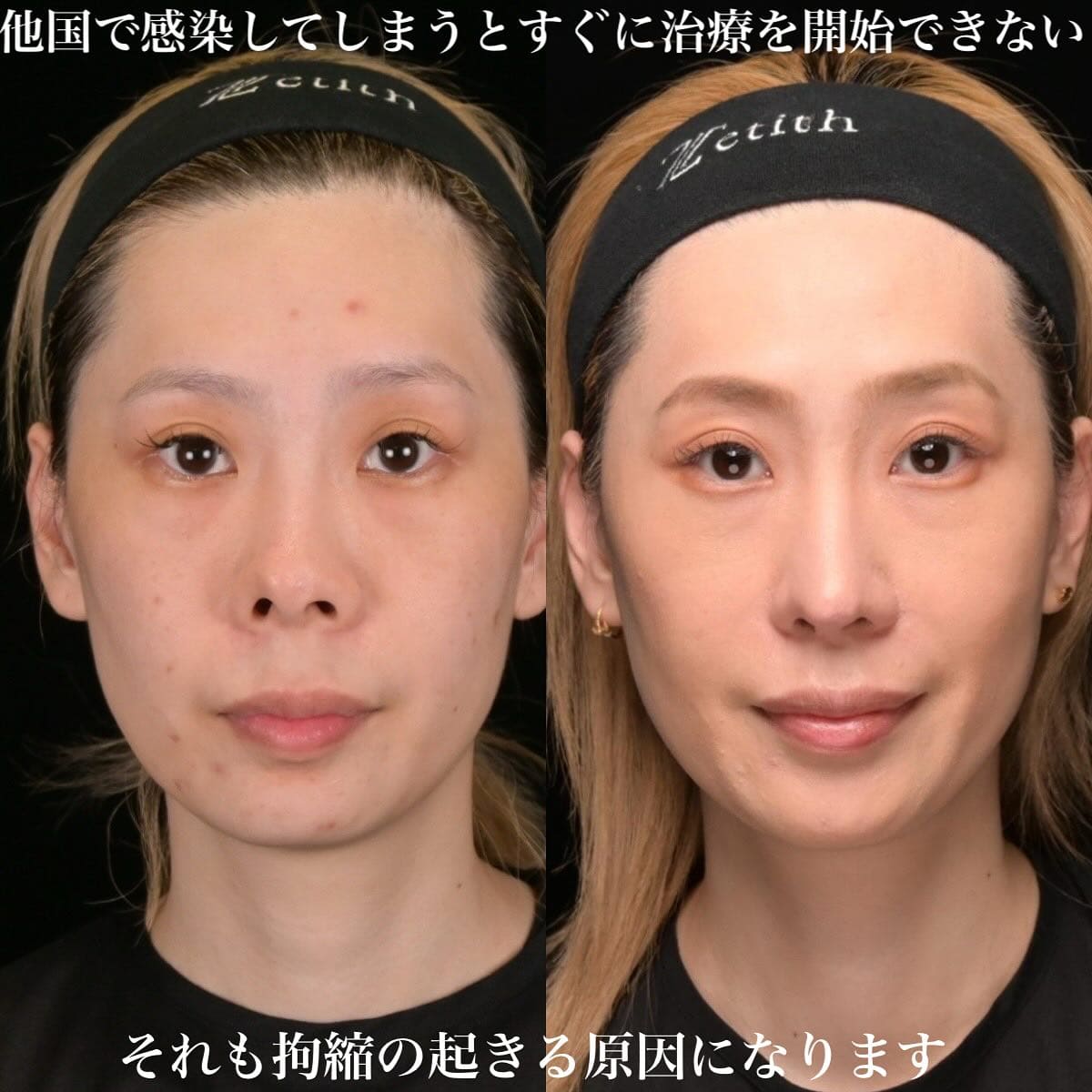 鉄医師による鼻整形の術前/術後6ヶ月