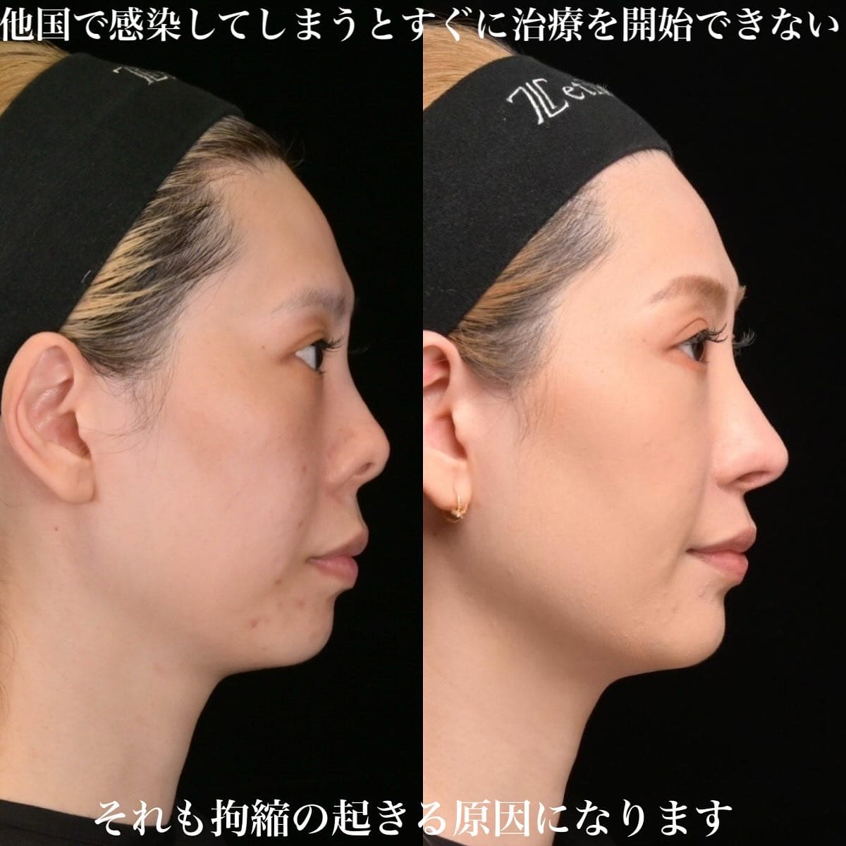 鉄医師による鼻整形の術前/術後6ヶ月 施術後 