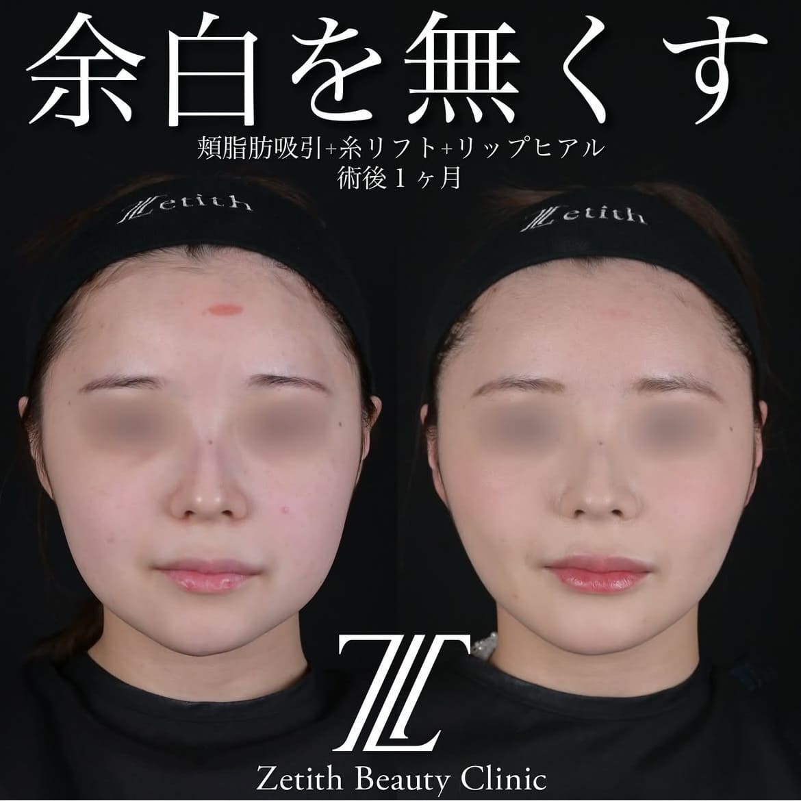 北村医師による脂肪吸引リフトの術前/術後1ヶ月
