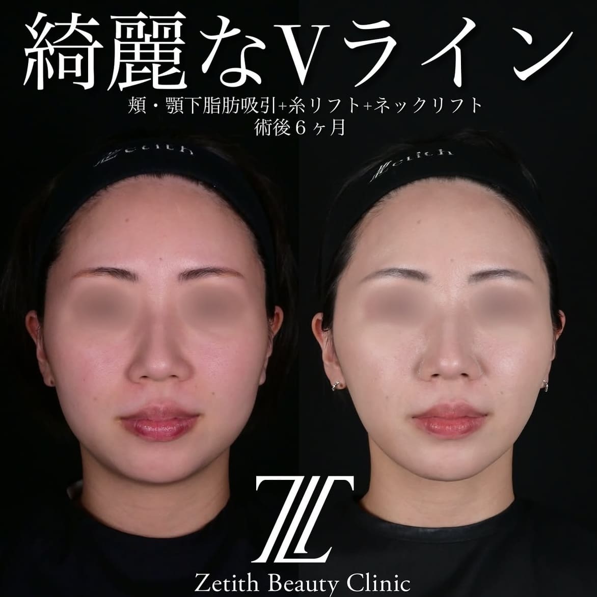 北村医師による脂肪吸引リフトの術前/術後6ヶ月
