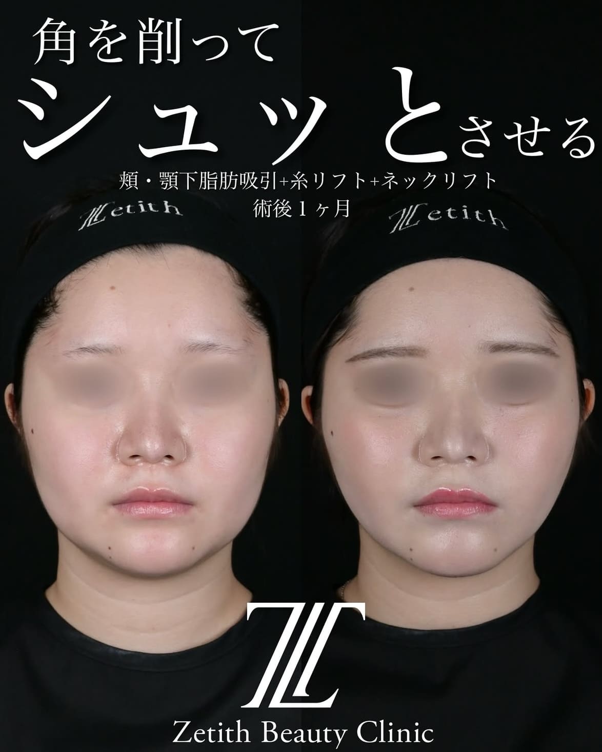北村医師による脂肪吸引リフトの術前/術後1ヶ月