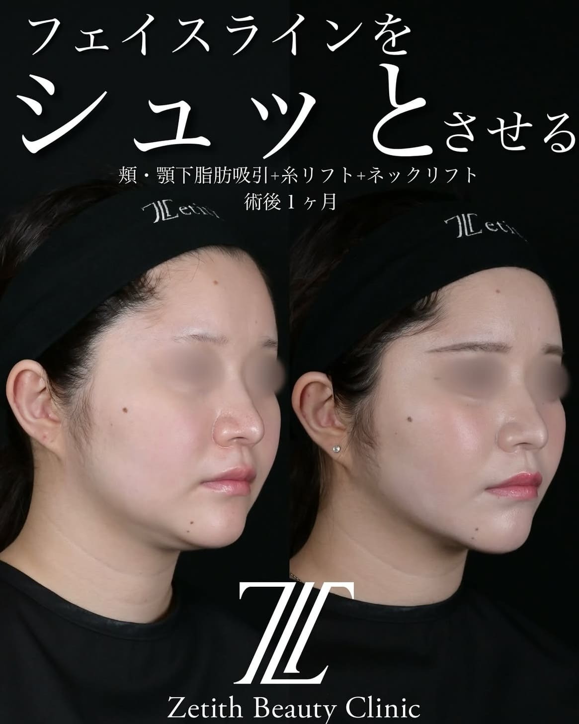 北村医師による脂肪吸引リフトの術前/術後1ヶ月 หลัง 