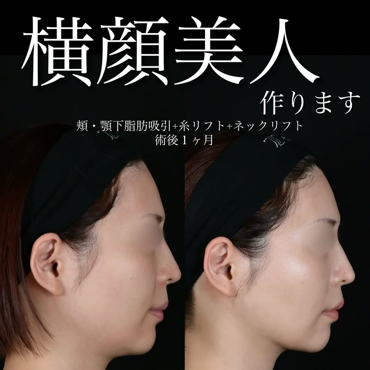 北村医師による脂肪吸引リフトの術前/術後1ヶ月 After 