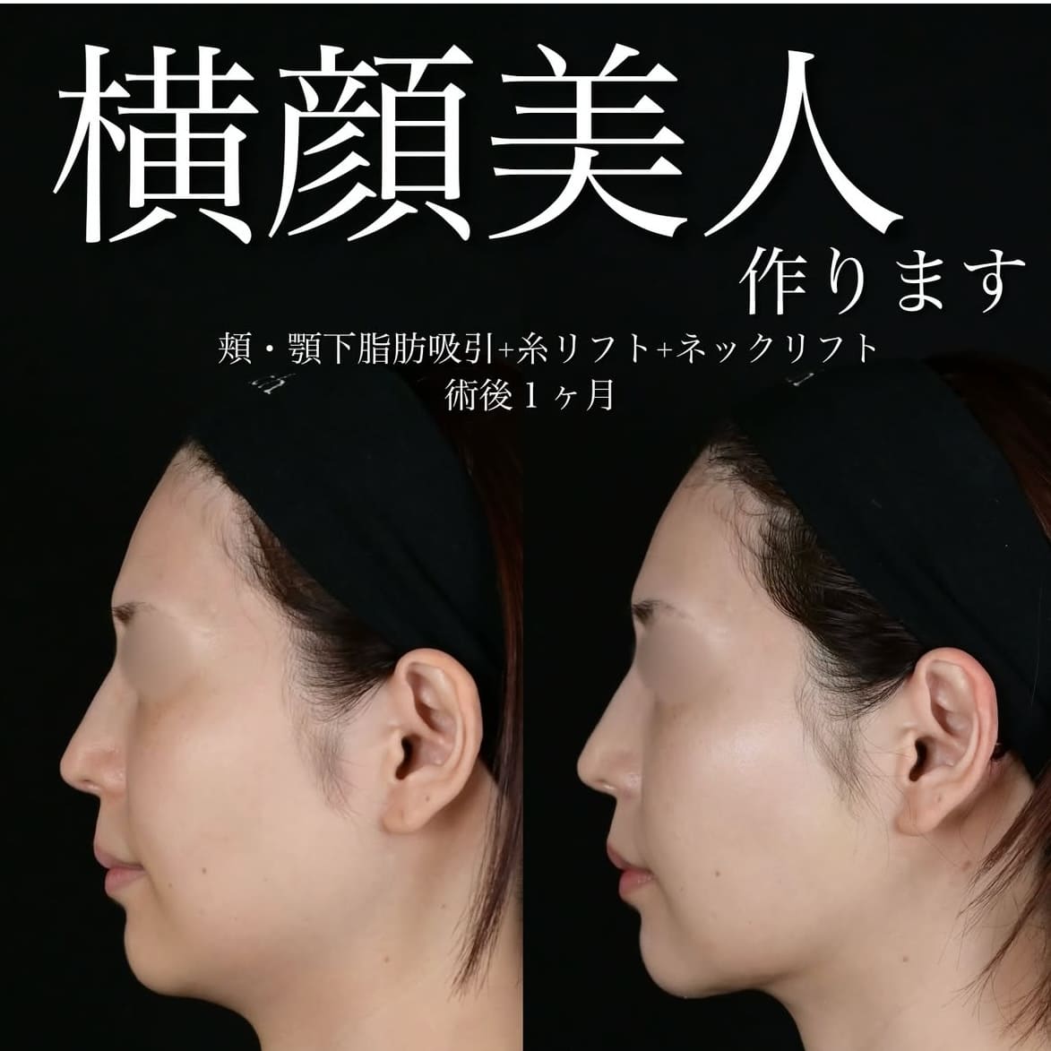 北村医師による脂肪吸引リフトの術前/術後1ヶ月