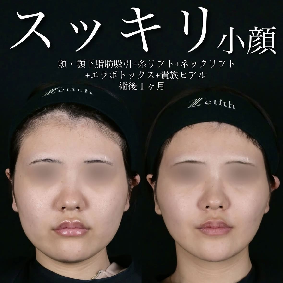 北村医師による脂肪吸引リフトの術前/術後1ヶ月後
