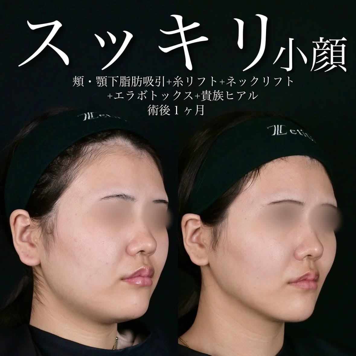 北村医師による脂肪吸引リフトの術前/術後1ヶ月後 术后 