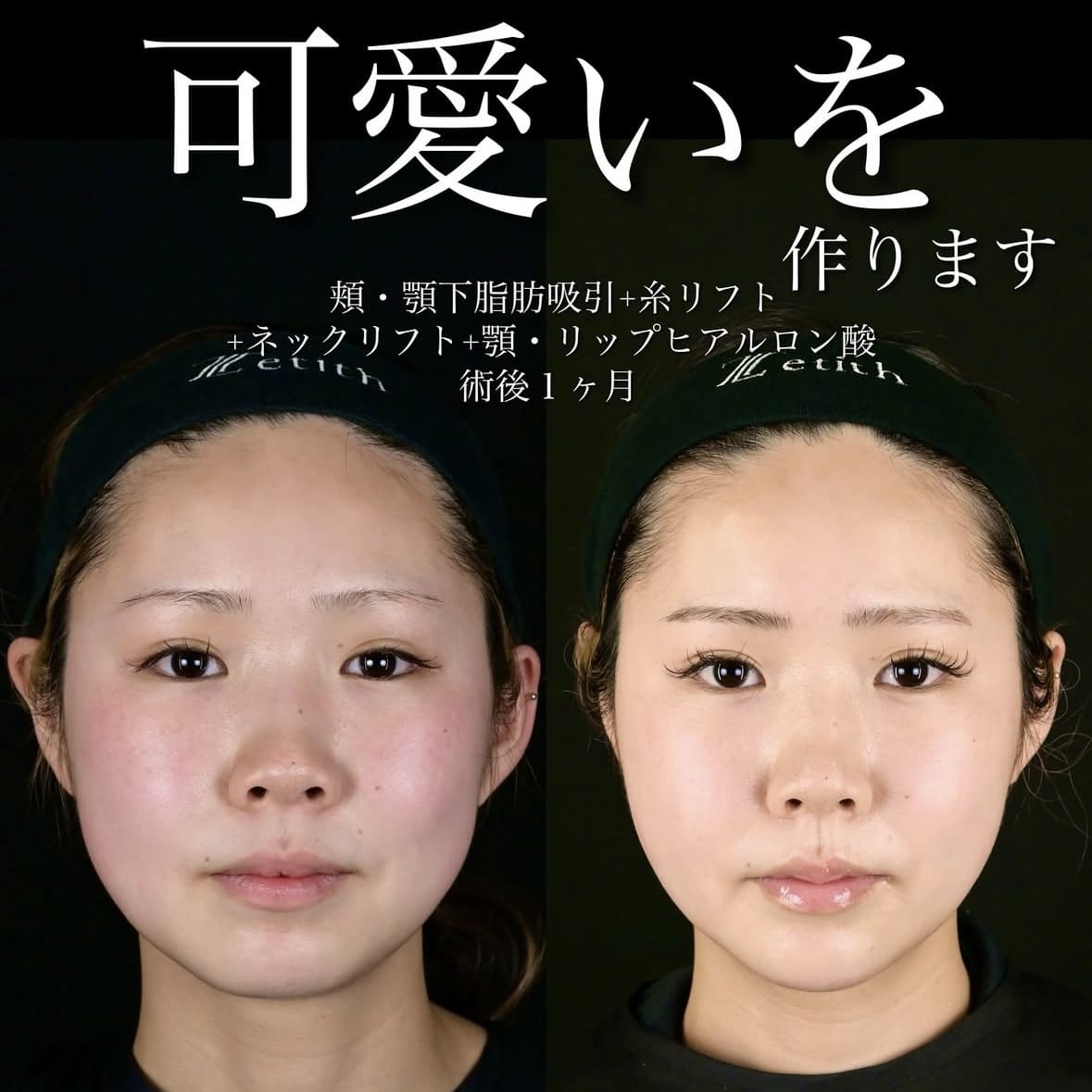 北村医師による脂肪吸引リフトの術前/術後1か月