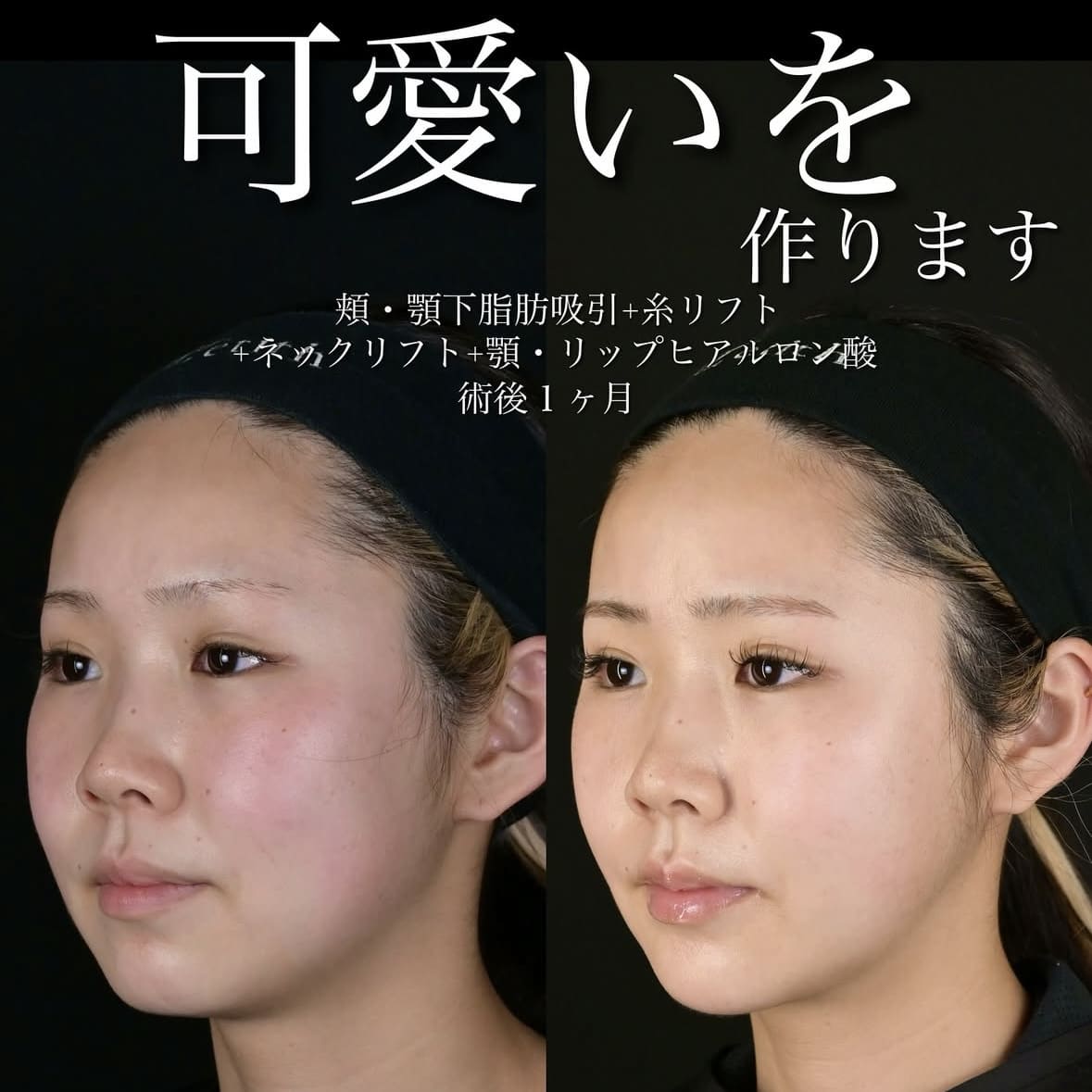 北村医師による脂肪吸引リフトの術前/術後1か月 หลัง 