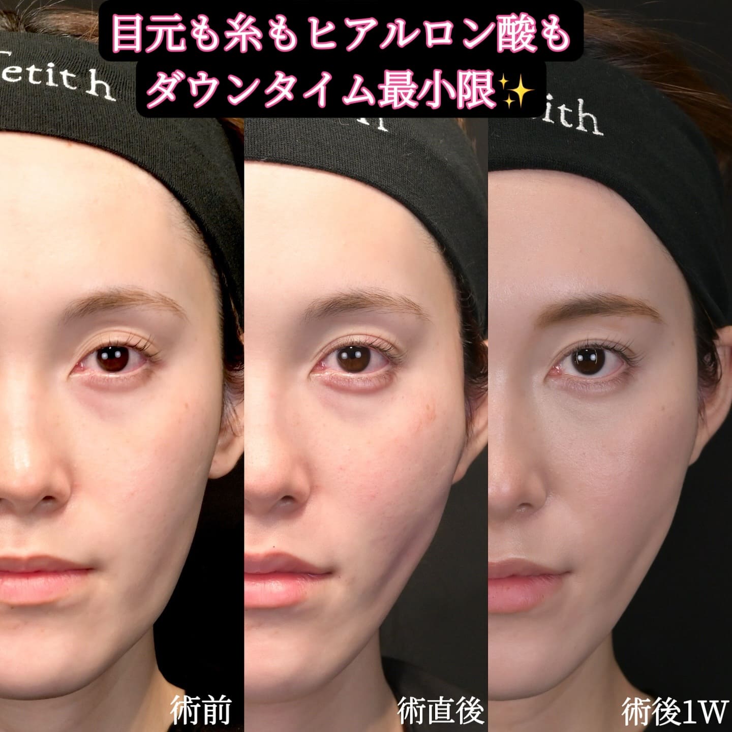 沈医師による複合施術の術前/術後1ヶ月 施術後 