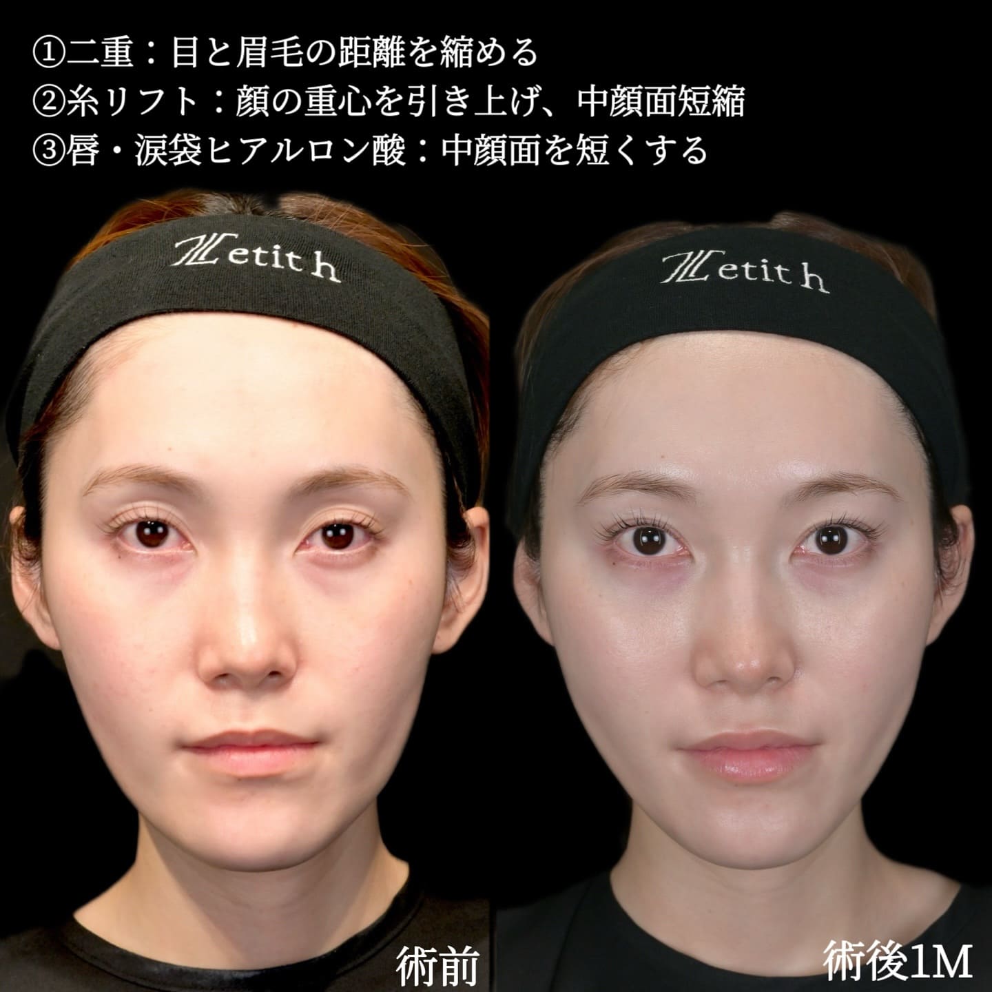 沈医師による複合施術の術前/術後1ヶ月