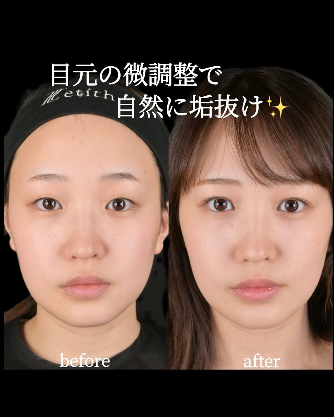 沈医師による目元形成の術前/術後1ヶ月