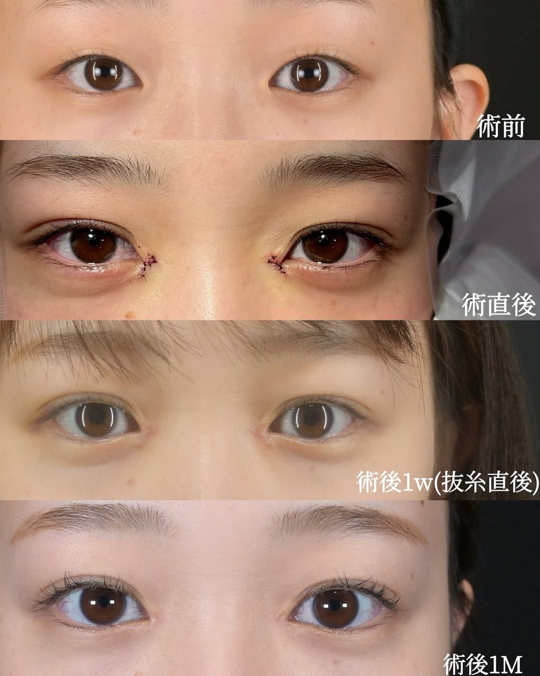 沈医師による目元形成の術前/術後1ヶ月 หลัง 