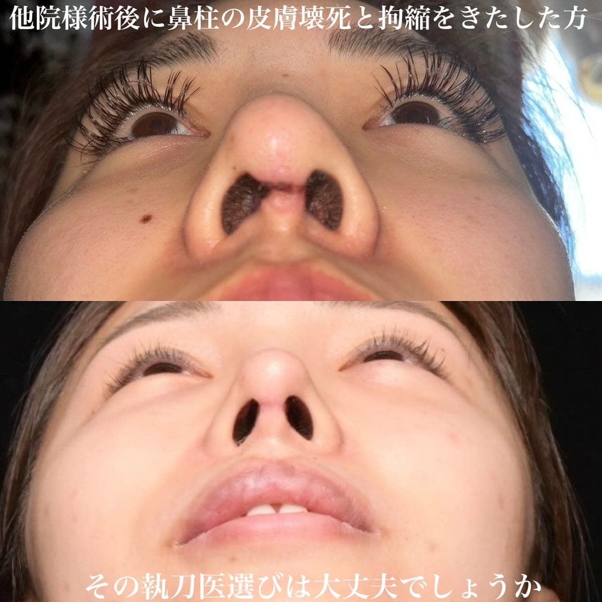 鉄医師による鼻整形の術前/術後３ヶ月 施術後 