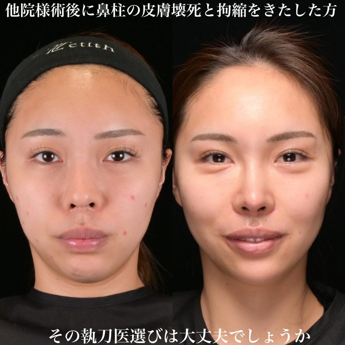 鉄医師による鼻整形の術前/術後３ヶ月