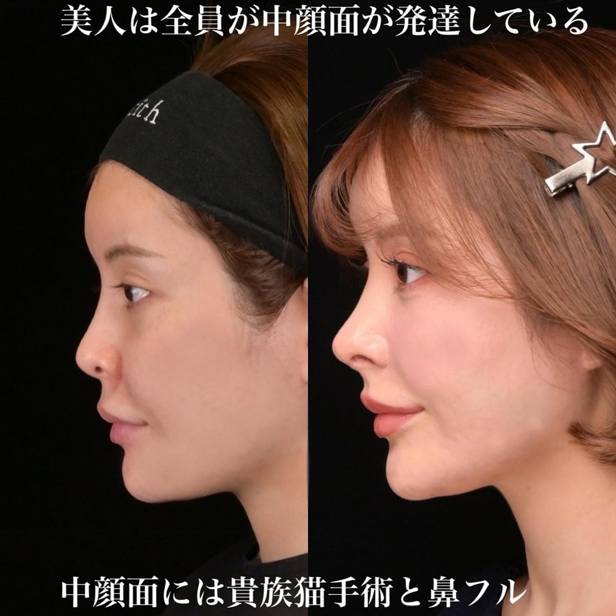 鉄医師による鼻整形の術前/術後３ヶ月 หลัง 