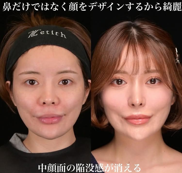 鉄医師による鼻整形の術前/術後３ヶ月