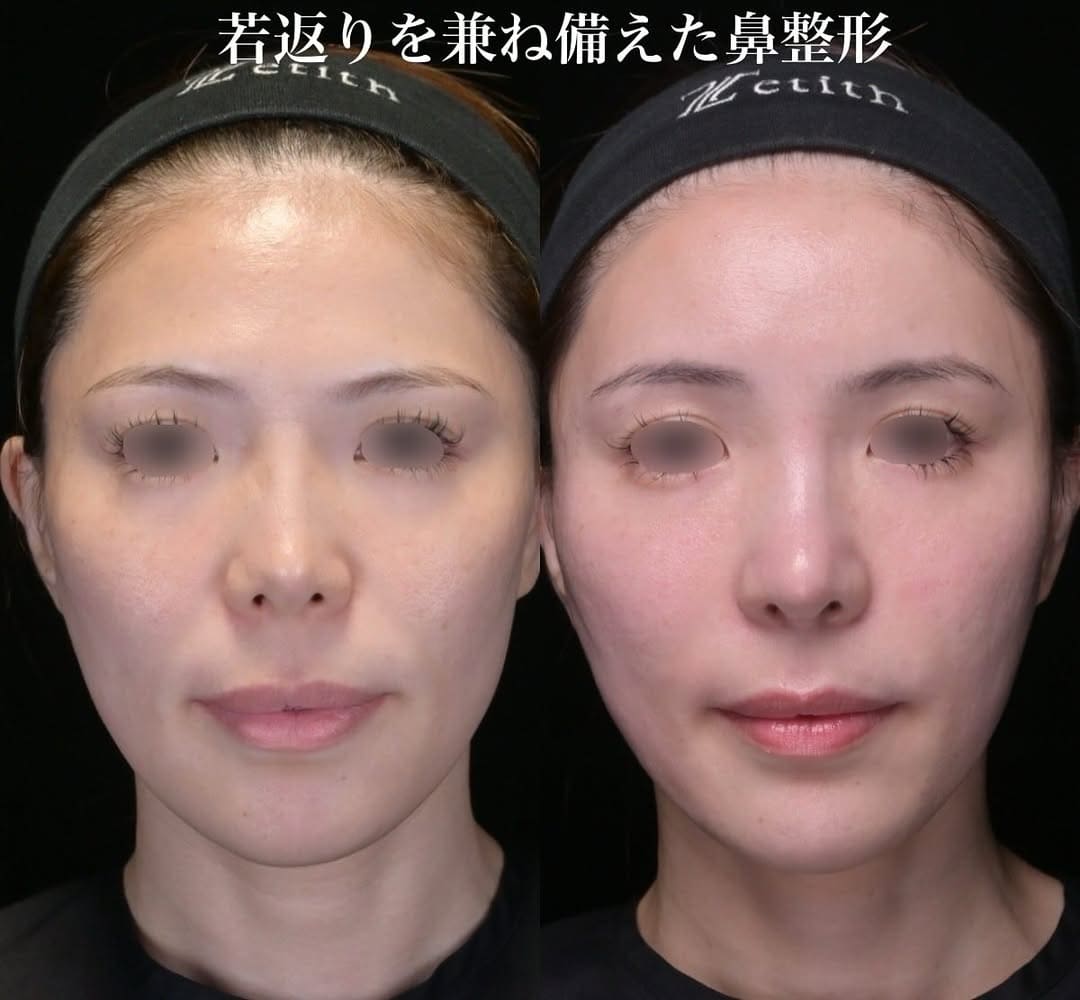 鉄医師による鼻整形の術前/術後3ヶ月